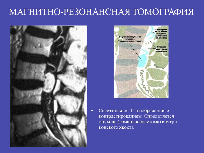 Сагиттальное Т1-изображение с контрастированием. Определяется опухоль (гемангиобластома) внутри конского хвоста  МАГНИТНО-РЕЗОНАНСНАЯ ТОМОГРАФИЯ